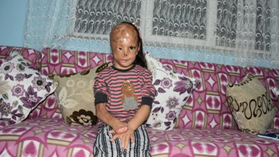 Dış görünüşü nedeniyle zor günler geçiren Dilara ameliyat için destek bekliyor