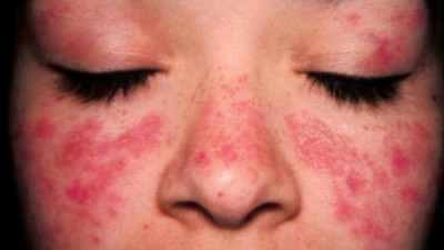 Kelebek hastalığı (lupus) neden olur, belirtileri nelerdir, nasıl tedavi edilir?