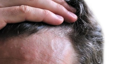 Seboreik dermatit nedir? Nasıl oluşur ve tedavi edilir?