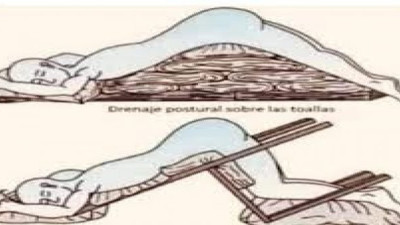 Korona virüste hayat kurtaran postüral drenaj yöntemi. Son çare birçok kişi böyle hayatta kaldı!