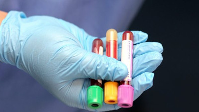 Uzun teşhis dönemi sona eriyor. Artık kan testi ile teşhis edilecek
