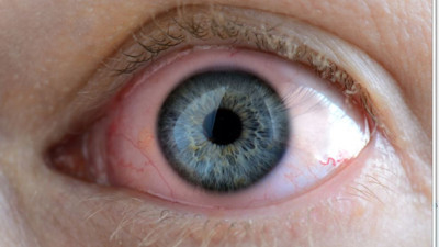 Gözlerinizde bunlar oluyorsa sakın Geçer demeyin. Birikince bakın neler yaşanıyor. Uzman doktor tek tek sıraladı