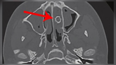 Kötü kokular geliyor deyince doktora gitti. Tam 8 yıl boyunca burnunda taşıdığı ortaya çıktı