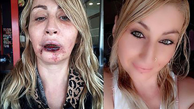 Estetik uğruna bu hale geldi. Canlı canlı çürüdü