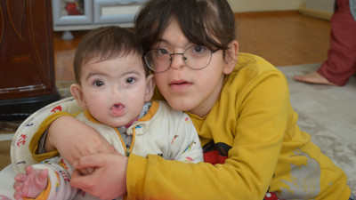 İki kardeş de aynı şekilde dünyaya geldi. Türkiye'de sadece 4 kişi böyle