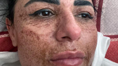 Estetiği kabusa dönüşmüştü. Dört ay sonra aynaya bakabildi