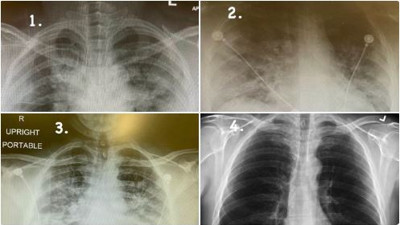 Eyvah Eyvah Covid yeni varyantlarla beraber gençlerde yayılıyor. Acil gençler de aşılanmalı. 4 tane röntgen örneği