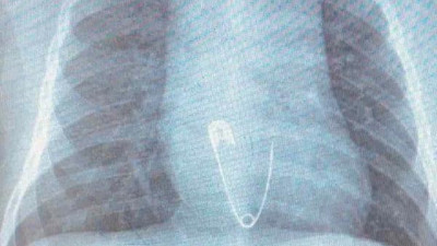 5 aylık çocuk nazar boncuğu iğnesini yuttu