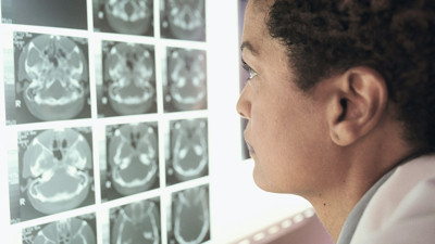 Şimdi de gizemli beyin hastalığı patladı. Bakın nasıl gelişiyor