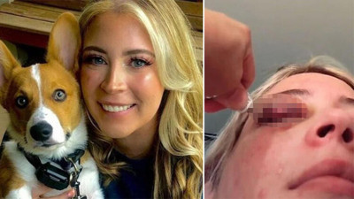 ABD'de köpek kadının göz kapağını ısırdı