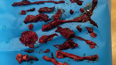 İşte koronadan sonra akciğerden çıkanlar