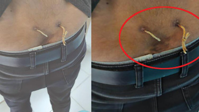 Muayene eden doktor şok oldu. Beline iki delik açıp çamaşır ipi geçirdiler