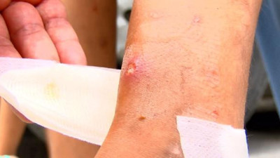 İstanbul'da büyük tehlike. Anında saldırıyor vücutta cılk yaralar oluşuyor