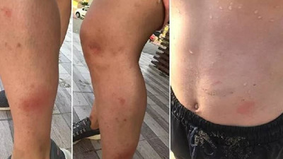 Denize giren herkeste kaşıntı başladı