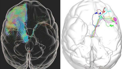 Parkinson hastalığı tarihe mi karışıyor
