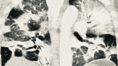 Aşı olanlarda korona virüs akciğere zarar vermiyor! İşte 2 kişiye ait tomografi sonuçları