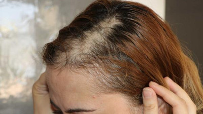 Hasta, hemşirenin saçını yoldu