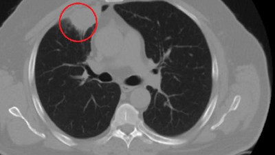 Dünya tıp literatüründe bir ilk. Korona akciğer kanserini taklit etti