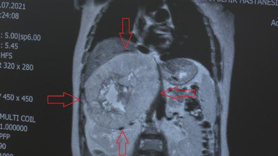 Karnından çıkanı gören doktorlar gözlerine inanamadı