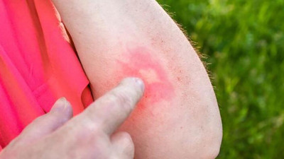 Yılan ısırığının zehirli olup olmadığını nasıl anlarsınız. Tıklayın öğrenin!