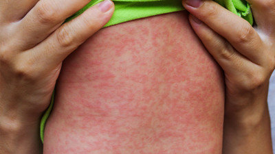 22 milyondan fazla çocuk kızamık aşısı olamadı