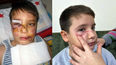 Köpekler saldırdığı için yüzüne 60 dikiş atılmıştı. Zavallı çocuk 36 gün sonra ilk defa dışarı çıkabildi