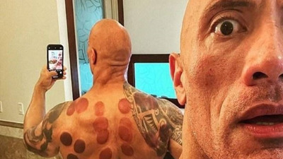 Dünya ünlüleri hacamata sarıldı. Hacamatın saymakla bitmeyen faydaları