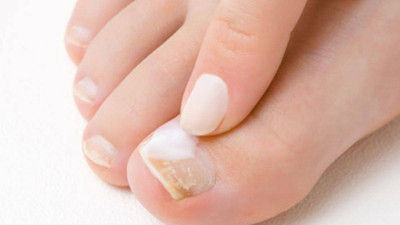 Tırnak mantarından kurtulmak istiyenlere ilaç gibi tavsiye