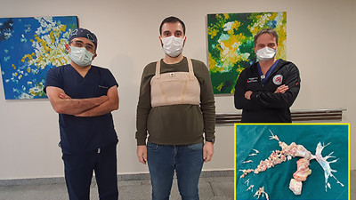 Ameliyatta ortaya çıkan gerçek doktorları bile şaşırttı. Dünya’da ilk vaka olarak literatüre girecek