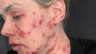 Bir krem hayatını kararttı