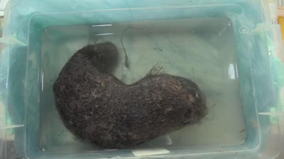 Midesinden 1,5 kilogram taşlaşmış saç yumağı çıktı