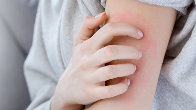 Pandemi döneminde uyuz vakalarında artış görüldü