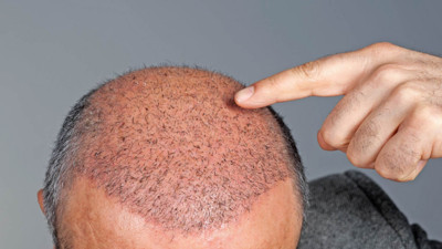 Diyanet'ten 'saç ekimi' fetvası: Zorunlu hâller dışında caiz değildir