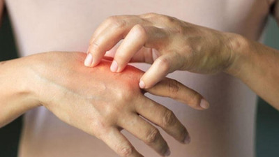 Soğuk yanıklarına dikkat!