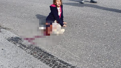 Sokak köpeklerinden kaçarken kamyon altında kaldı, bacağı kesildi. Sokak köpeklerini savunanlar bu kızın bacağını kim geri getirecek