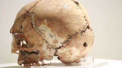 Dünyanın ilk beyin ameliyatı Türkiye'de yapıldı