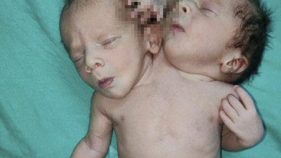 Çift başlı bebeği görenin ağzı açık kaldı