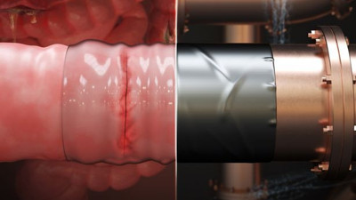 ABD'li araştırmacılardan cerrahi koli bandı
