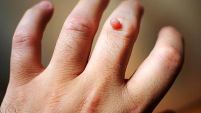 Siğiller için 10 doğal çözüm