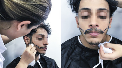 Saç ekimi yöntemiyle kaş ve sakal da ekilebiliyor