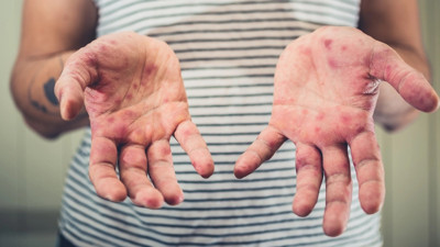 Korkutan yeni salgın uyarısı: 200 milyon insan tehlikede