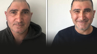 Kafatasının yüzde 83'ü parçalandı: Mucizevi yöntemle eski haline kavuştu!