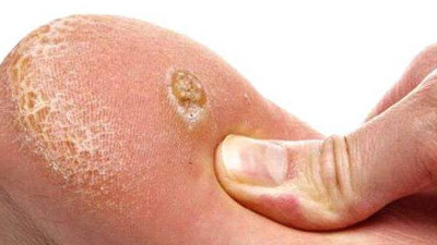 Her yerde arayıp da bulamadığınız çözümler: Nasırınızın kökünü kurutacak yöntemler