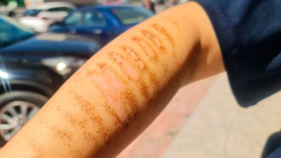 Epilasyon için gittiği güzellik merkezinde kolları yandı