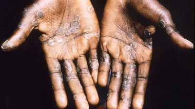 Maymun çiçeği virüsü alarmı: 12 ülkede görüldü