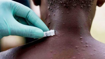 Bilim insanların maymun çiçeği virüsü uyarısı