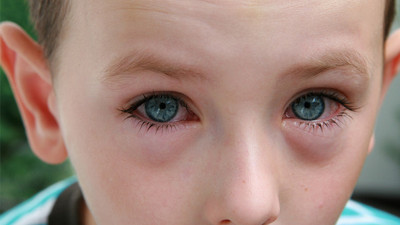 Anne babalar çocuklarda göz kızarıklığına dikkat!