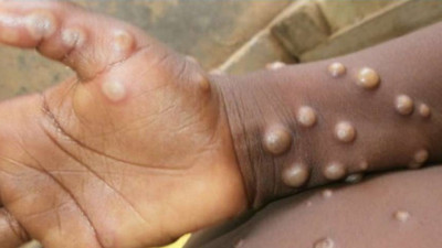 Türkiye'de maymun çiçeği vakası var mı? Fahrettin Koca açıkladı