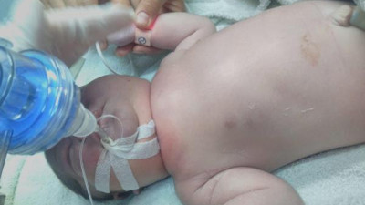 Doğumda köprücük kemiği kırılan bebek entübe edildi! Aile hastane ve doktor hakkında suç duyurusunda bulundu