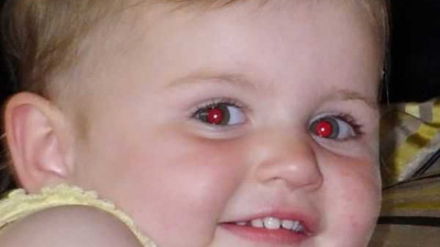 Çocuk fotoğraflarında kırmızı çıkan göz bebeği neyin habercisi?